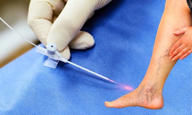Tindakan Skleroterapi Prosedur Medis Untuk Mengatasi Varises