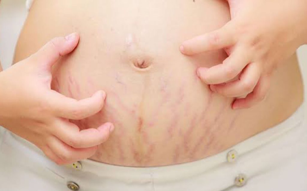 Selulit Atau Stretch Mark Sering Terjadi Pada Ibu Hamil