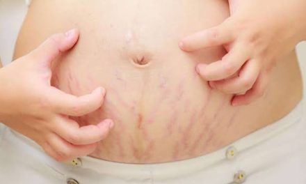 Selulit Atau Stretch Mark Sering Terjadi Pada Ibu Hamil