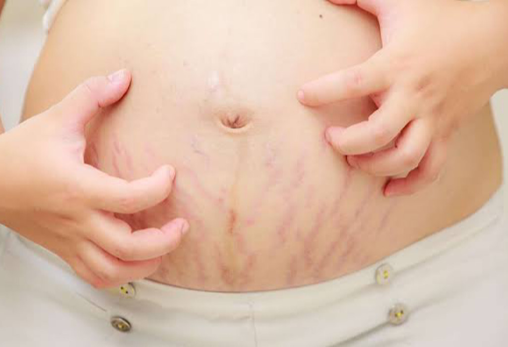 Selulit Atau Stretch Mark